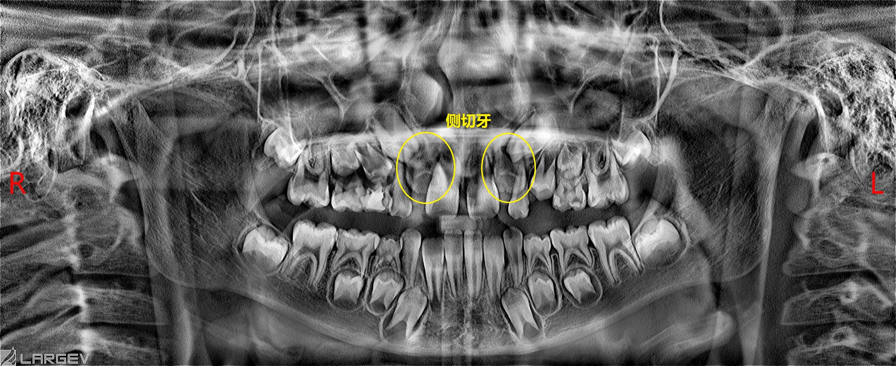 小孩大门牙中间有缝,男人门牙中间有缝面相