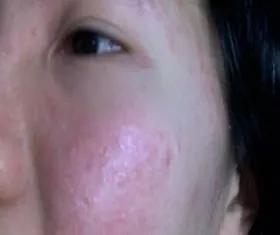 拯救痘痘烂脸用什么药,拯救痘痘烂脸这个小窍门你知道吗