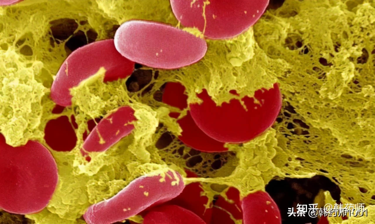 一级高血压如何锻炼调理,高血压怎么形成的原因是什么