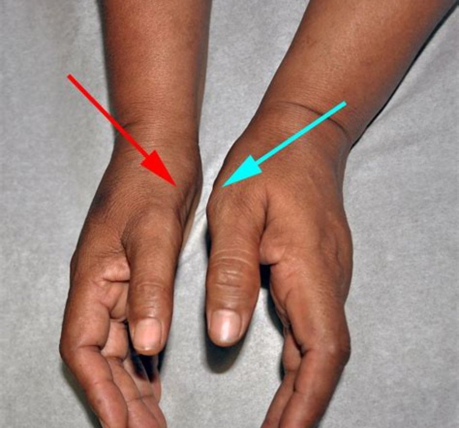 手麻是什么原因导致的怎样治疗,手麻是五种原因引起的要警惕