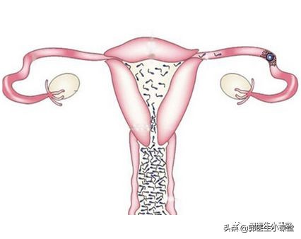 女方输卵管堵塞做第几代试管婴儿,22岁输卵管堵塞做试管婴儿成功率