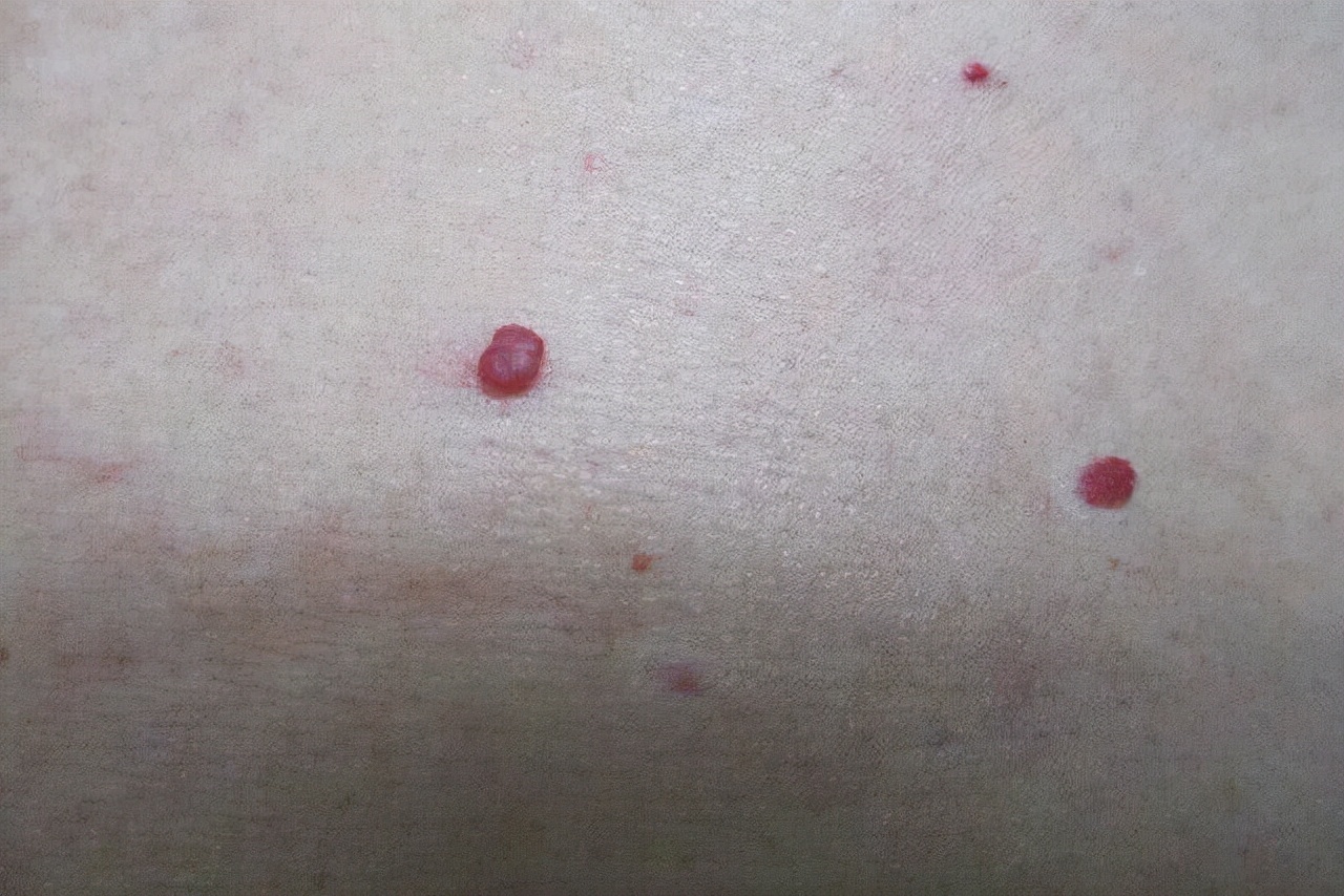 手臂有小红点是什么原因,手臂上出现很多小红点是什么原因