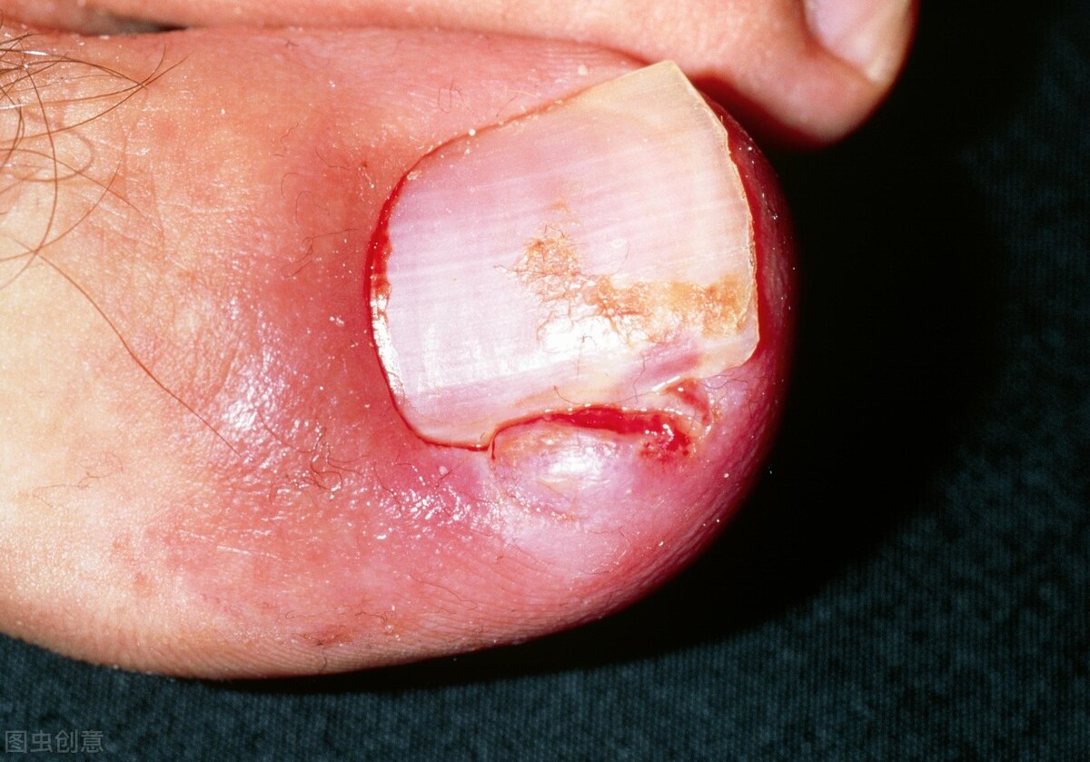 脚趾甲沟炎特别疼怎么办,脚趾甲甲沟炎疼怎么处理