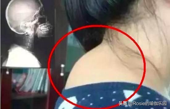 富贵包快速消除背部方法,为什么背有富贵包