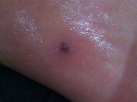 人类破伤风,人类怕破伤风吗