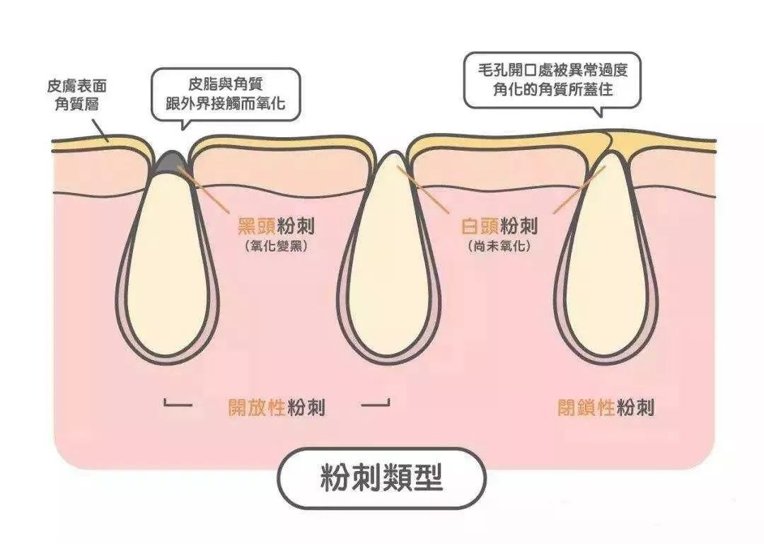 挤痘进了ICU，连下两次病危通知？这痘痘到底还能不能挤！