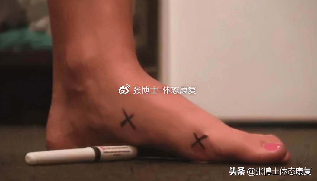 扁平足矫正的最佳年龄怎么矫正,扁平足的矫正方法舞蹈