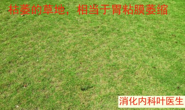 广泛肠上皮化生与肠上皮化生区别,肠上皮化生一定会癌变吗