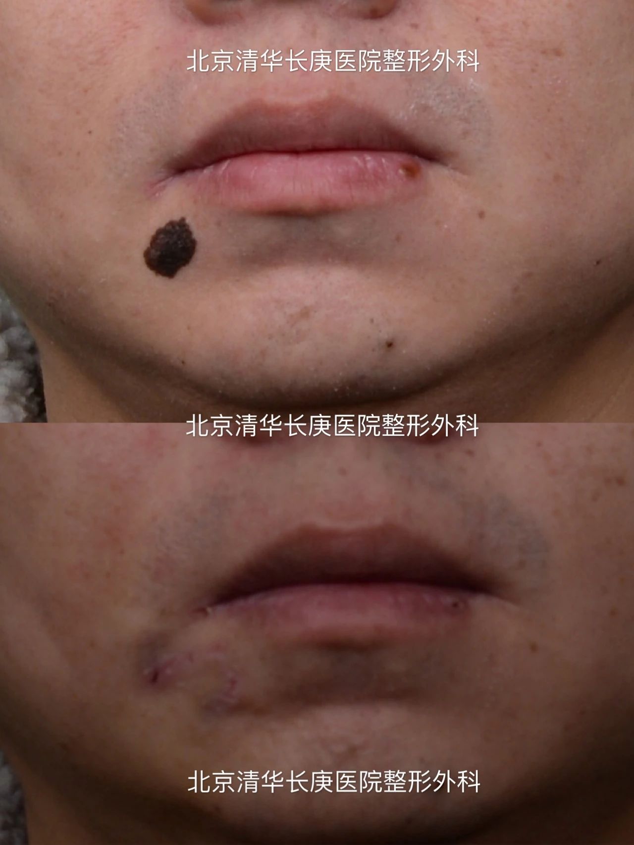 体表肿物系列案例-恶性黑色素瘤