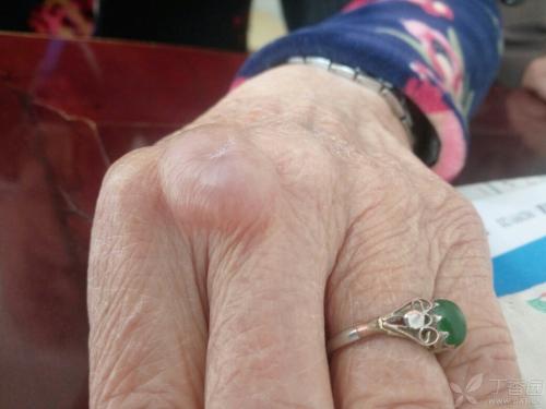 囊肿长哪地方,囊肿一般长在什么地方