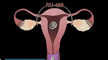 25岁的女生有几次打胎,女子堕胎6次连医生都惊讶了