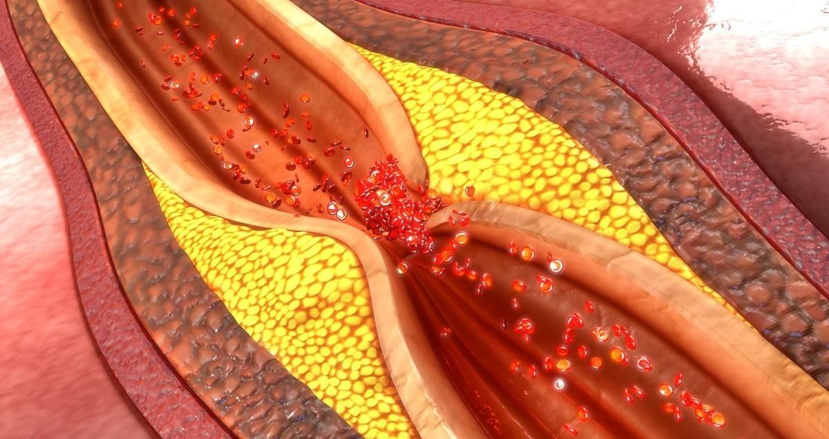 动脉粥样硬化斑块吃哪种他汀最好,他汀类药物对于动脉斑块有作用吗