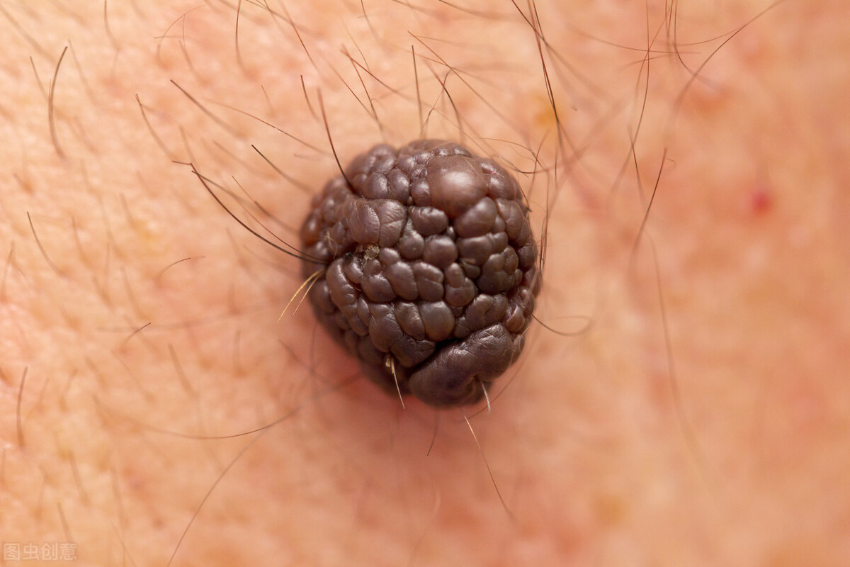 有哪些痣会变癌症,肉痣有癌变的可能吗