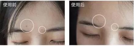 抗痘抑菌凝胶,祥顺比尔霍夫抑菌凝胶治理皮癣