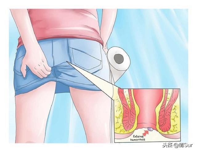 排便不顺、便血、便秘、肛门肿痛？妊娠期痔疮如何预防和缓解？