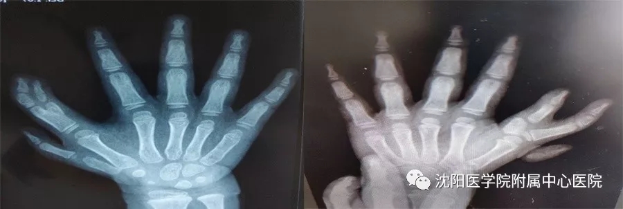 完美矫治畸形双手——沈医中心医院为先天有14根手指的小女孩成功再造健康双手