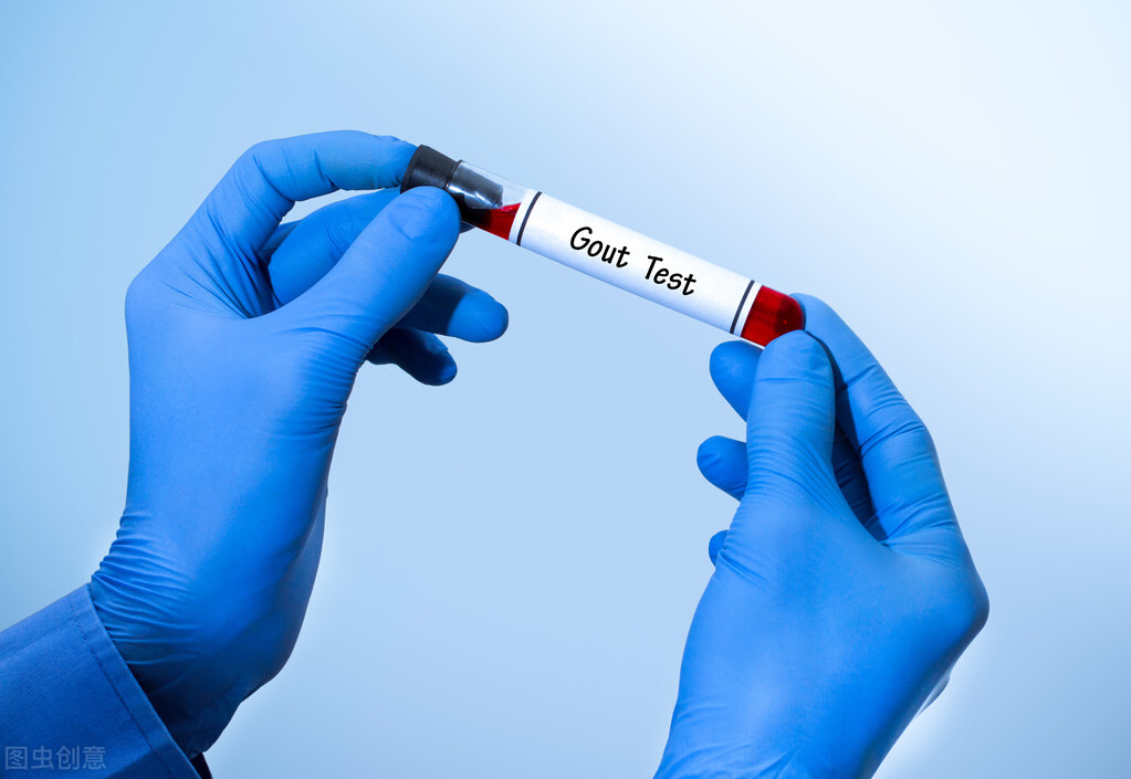 尿酸过高的人得警惕这几个危害,尿酸高该不该用药记住这两个指标