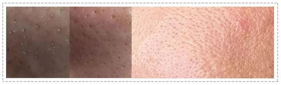 橘子皮怎么收缩毛孔,毛孔粗大橘子皮肤质还有救吗