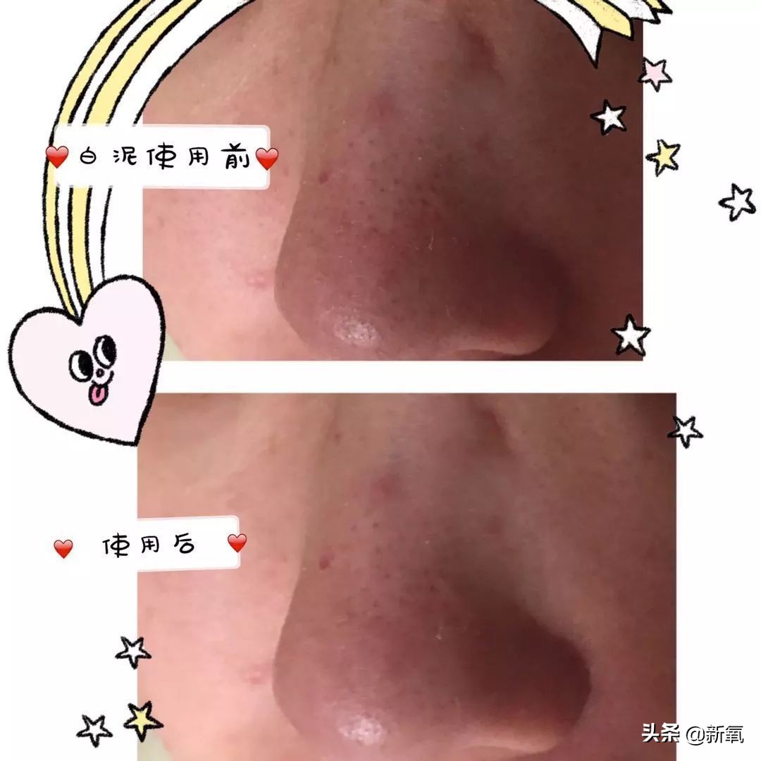 亲测非常有效的去黑头方法,去黑头最有效的方法三天见效