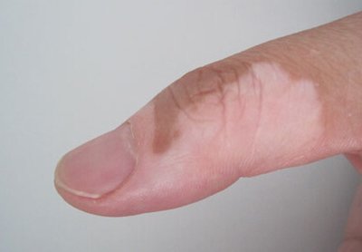 小孩怎么区分白斑和白癜风,如何辨别白斑和白癜风区别