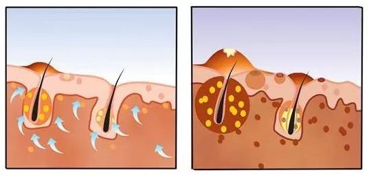 头皮和脸上长痘痘,小孩头皮上长痘痘