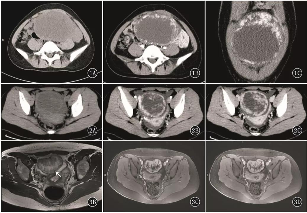 卵巢实性为主肿瘤，这13种你都想到了吗？