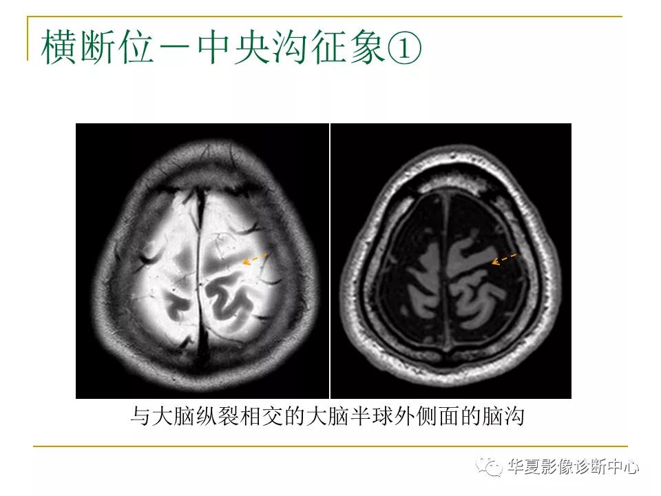 中国人脑立体定向mri应用解剖图谱,脑mri示意图
