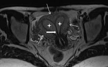 子宫偏小不治疗怀孕容易流产,子宫偏小容易流产怎么办
