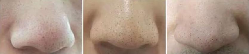 家用便携可视化祛黑头仪,金稻可视化吸黑头仪评测