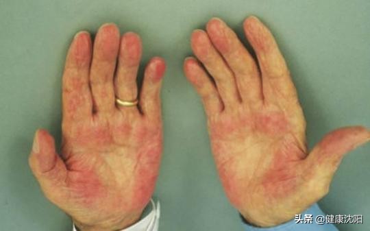 全国爱肝日肝病临床试验报告,全国爱肝日携手消除肝炎危害