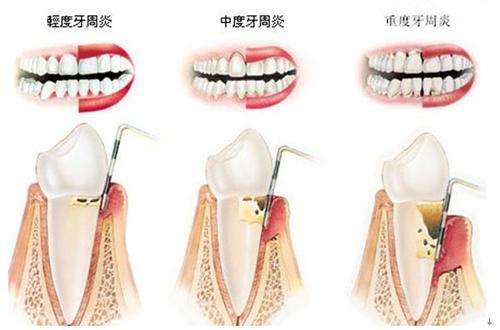 牙龈萎缩导致塞牙最好的解决办法,牙龈萎缩前牙黑三角严重如何修复