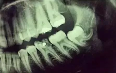 看牙不拍片直接说费用,医院看牙拍片贵吗