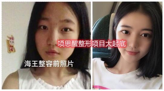 项思醒眼部整容史,项思醒整容了吗