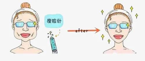 瘦脸针国产进口怎么选,瘦脸针进口牌子价格表