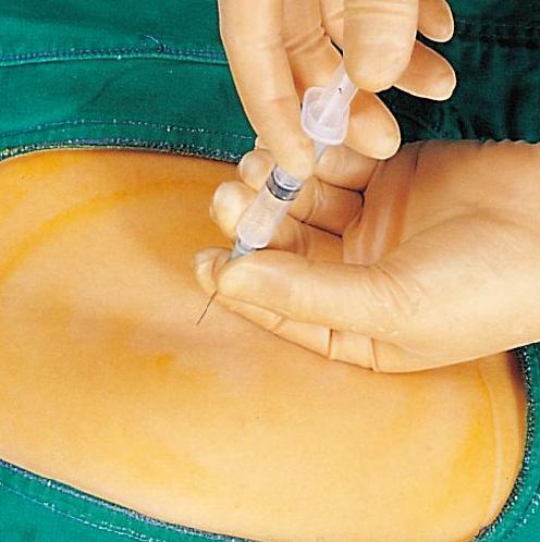 宝宝顺产出生的过程,剖腹产的小孩比顺产的小孩胆小吗