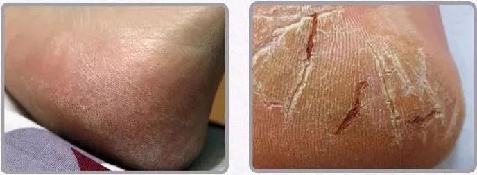 冬季皲裂膏预防脚后跟干裂好用的,上热门脚后跟干裂保湿霜