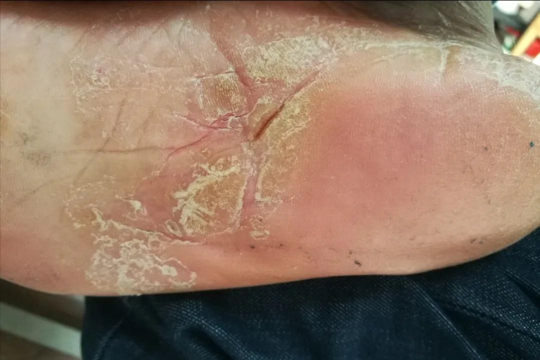 你以为的脚气还不是脚气