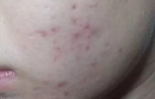 如何祛除痘印最有效的几招,教你几种有效去除痘印的方法