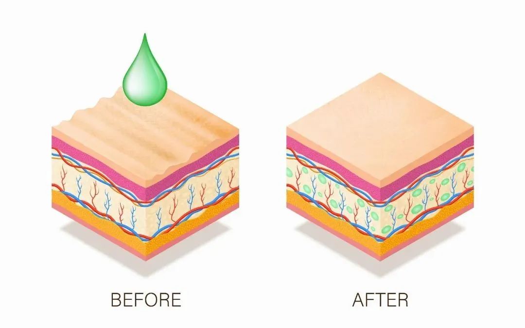 抬头纹去除真的有效吗,抬头纹法令纹真的可以消灭吗