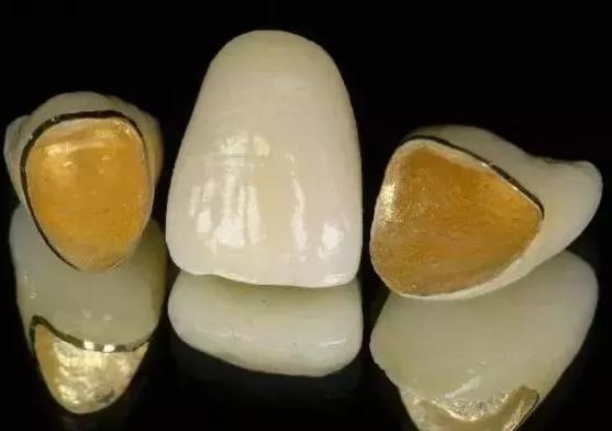 做烤瓷牙的利弊与危害,烤瓷牙失败的原因及解决方法