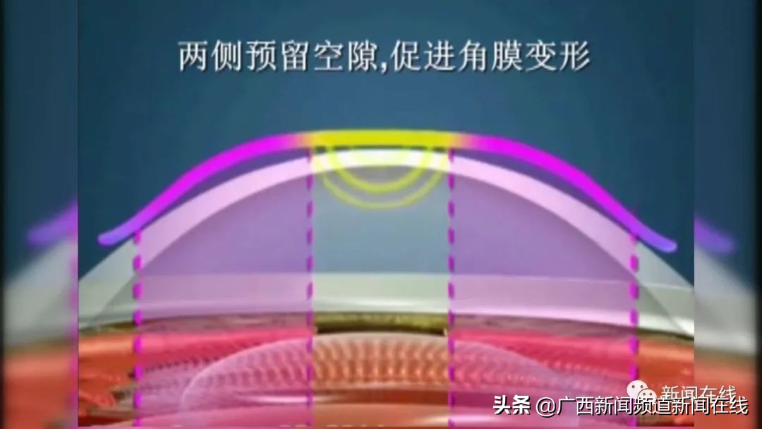 近视矫正ok镜为什么叫ok镜,戴ok镜度数退了要换新的ok镜吗