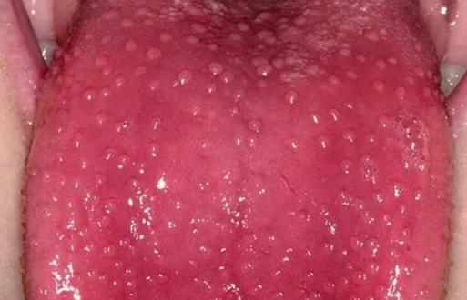 猩红热为什么会全身发热,猩红热和风疹发热的区别