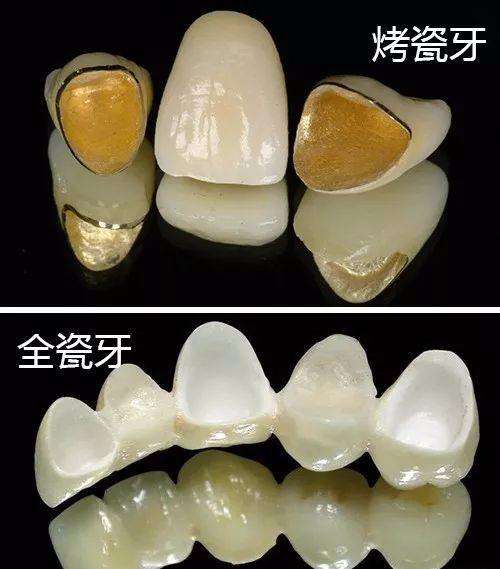 全瓷牙和金属烤瓷牙哪个容易崩瓷,含金属烤瓷牙套好还是全瓷牙套好