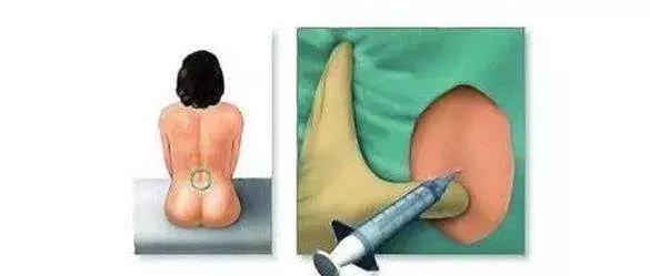 无痛分娩腰疼多久能恢复,无痛分娩对分娩时腰疼有没有作用