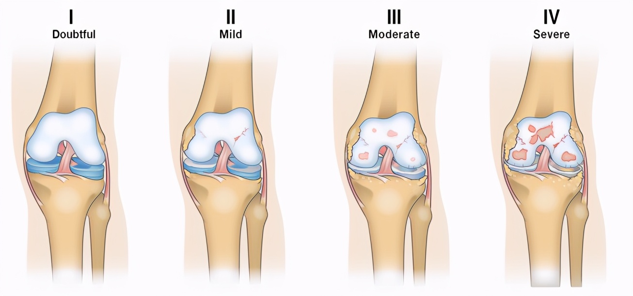 膝前疼痛如何治疗,髌骨软化症的症状与保守治疗方法