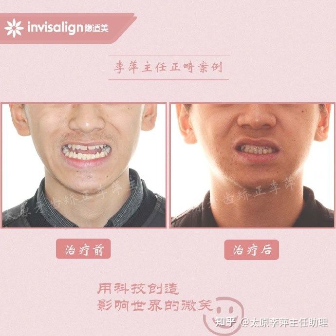 太原牙齿矫正靠谱吗,太原成人隐形牙套牙齿不齐