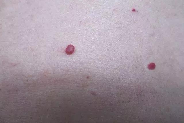 出现痣警惕肝脏病变,肝痣是肝脏发出的求救信号