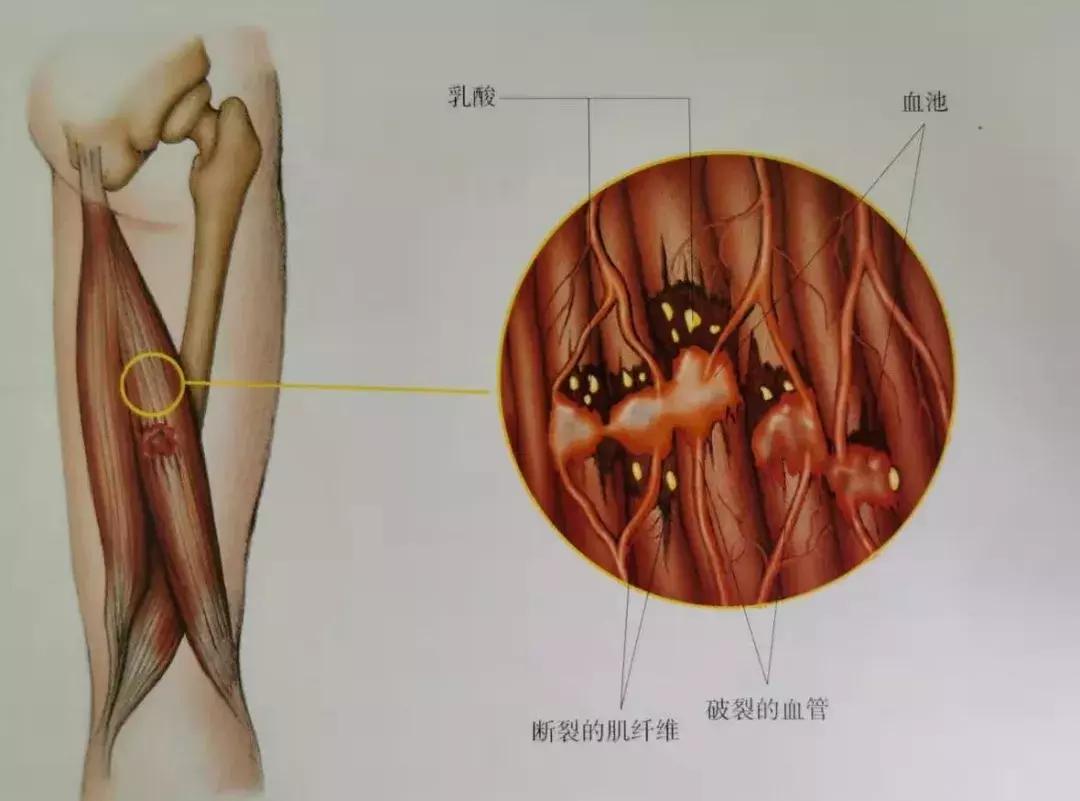 排毒拉筋,扯皮拉筋是成语吗