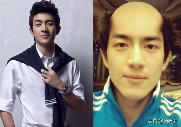 谢顶假发正反戴法,谢顶戴假发变化