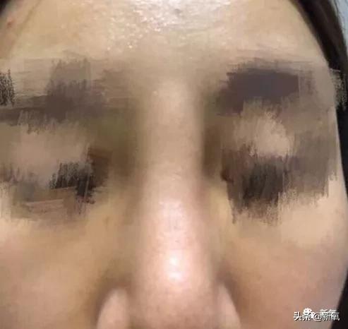 5分钟换头术视频,3分钟隆鼻是什么技术